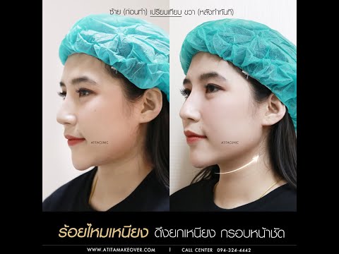 ร้อยไหม