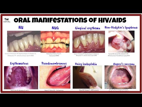 Oral manifestations of HIV/AIDS | Oral Medicine