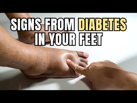 Don't ignore! A doctor explains the early symptoms of diabetes foot, a regrettable complication.