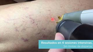 Laser Transdermico para varices y arañitas