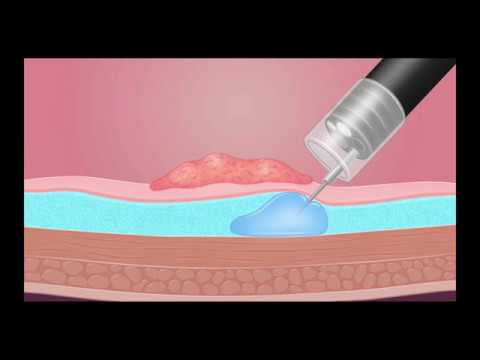 Colonoscopy: Injection technique for EMR - Graphic Illustration