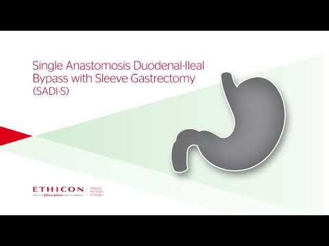 Single Anastomosis Duodeno–Ileal Bypass with Sleeve Gastrectomy (SADI-S) Animation