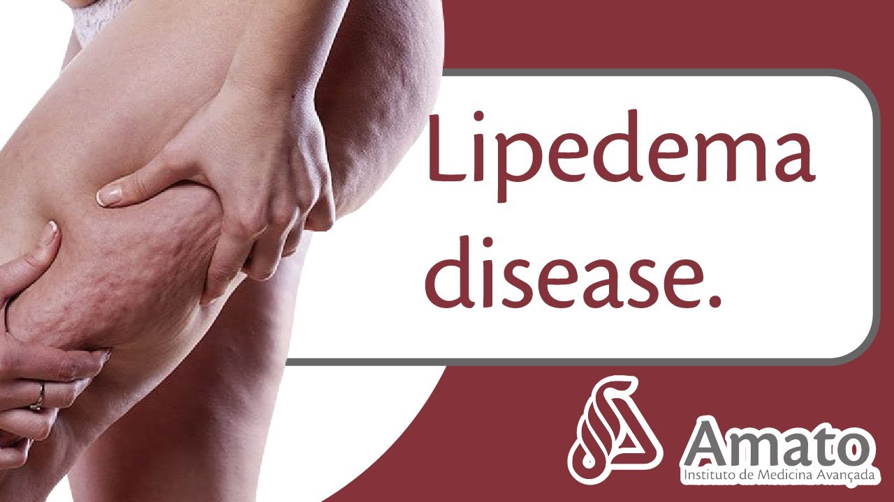 Lipedema disease (English subs)