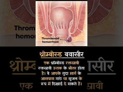 What is Thrombosed Piles (थ्रोम्बोस्ड बवासीर ) ? #youtube #shorts #yoytubeshorts