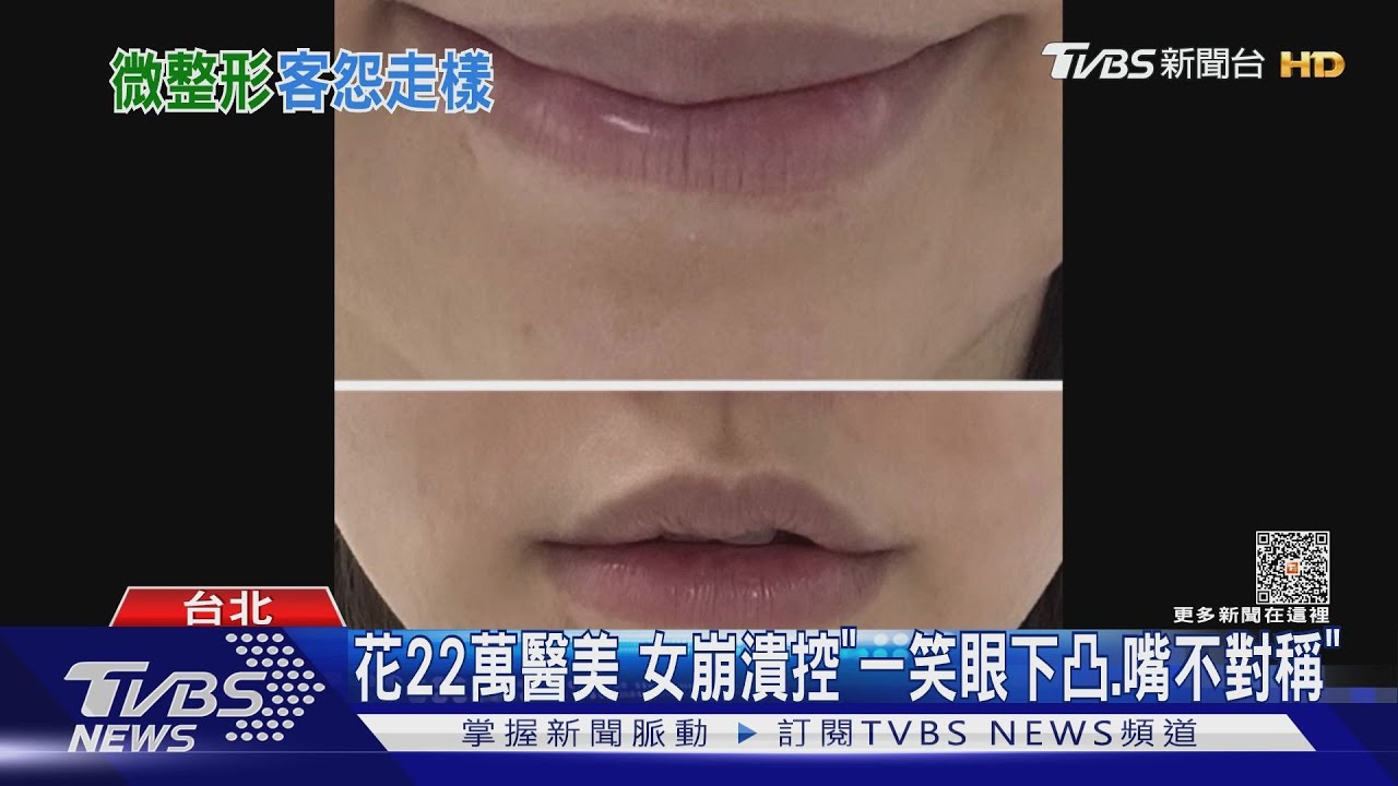 花22萬醫美 女崩潰控「一笑眼下凸、嘴不對稱」