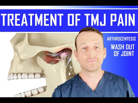 TMJ Pain Effective Treatment | How To Wash Out Joint | Arthrocentesis