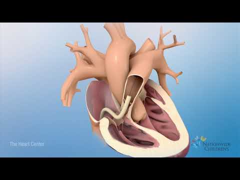 Tetralogy of Fallot (TOF): Animation Explains Heart Defect and Repair