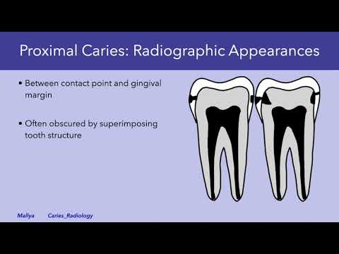 Radiologic Detection and Evaluation of Caries