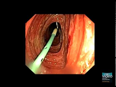Vascular Lesions in the Small Bowel