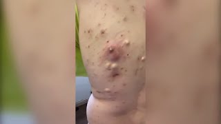 Popping huge blackheads and Giant Pimples - Best Pimple Popping Videos #83