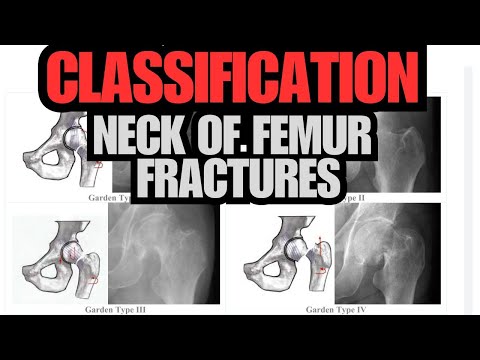 Understanding Femoral Neck Fracture Classifications: Pauwels & Garden Systems Explained