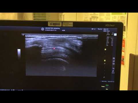 Subacromial Subdeltiod Bursa injection SASD