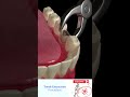 Tooth Extraction Animation - Aftercare View