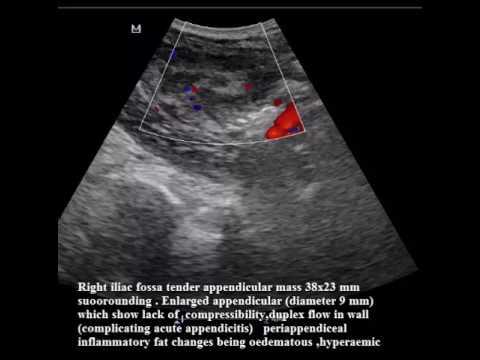 CASE 173 APPENDICULAR MASS