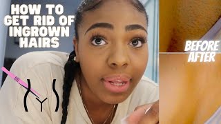 How To Get Rid Of Ingrown Hairs & Stay Razor Bump FREE