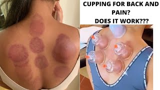 Cupping for back and neck pain? Does it work?