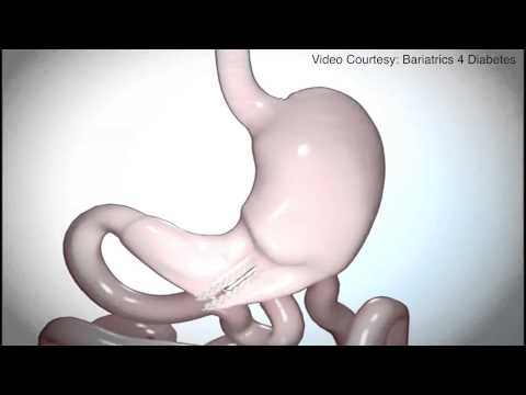 Bariatric Videos