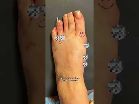 Bunion & Hammertoe Foot TRANSFORMATION!