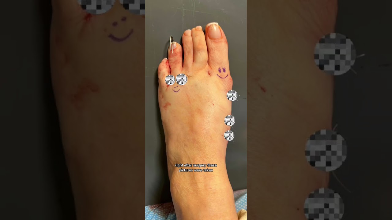 Bunion & Hammertoe Foot TRANSFORMATION!