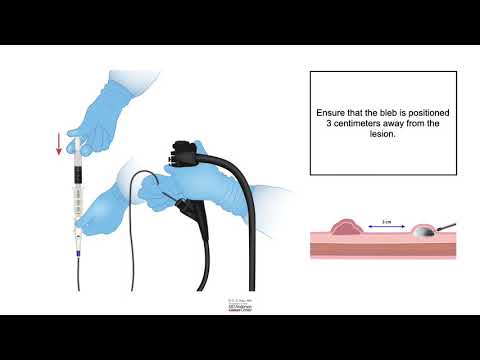 HCC 1472 15b3 Injection Tattoo