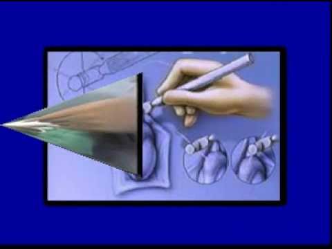 Microsurgical Epididymal Sperm Aspiration (MESA)