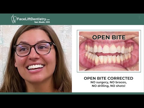 Open-Bite Fix, No Surgery or Braces, One Month