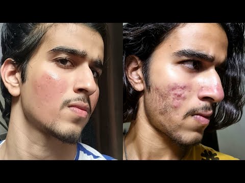 I Ruined My Skin, Here’s What Happened