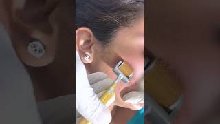 Why You Really Need DERMA ROLLER TREATMENT FOR ACNE SCARS | #viral  #shorts  | Skinaa Clinic