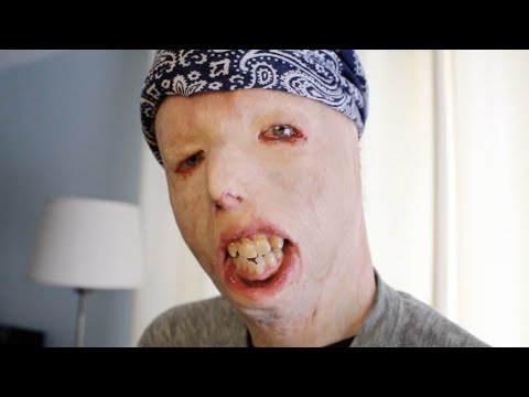 'Joy'- Dave Hammer: Burn Survivor Documentary