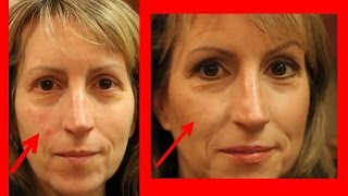 COVER RED SPOTS ON THE FACE WITH MAKEUP