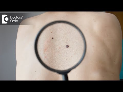 Is it normal for a mole to suddenly appear on skin? - Dr. Urmila Nischal