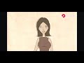 Plastic Surgery Breast Expansion Animation