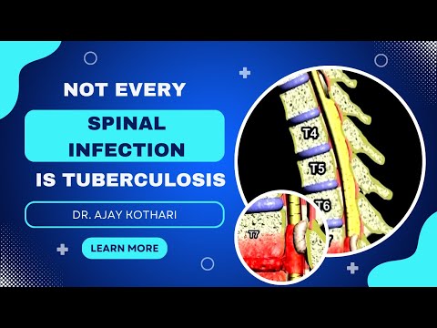 Not Every Spinal Infection Is TB | What Patients Must Know | Dr. Ajay Kothari