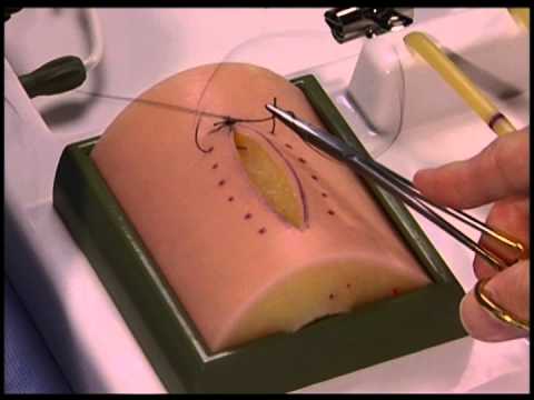 Simple Interrupted wound closure