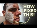HOW TO GET RID OF ACNE