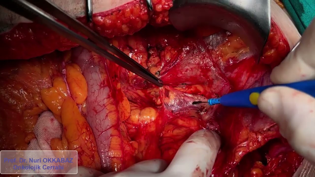 Pankreas kanseri cerrahisi - pankreas anastomoz aşaması