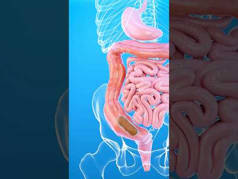 Qu'est-ce que la constipation ? 💩🤔