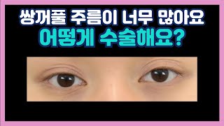 겹쌍꺼풀 고민? 해결 방법 알려드려요!