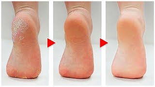 How to Get Rid of Calluses on Feet Naturally