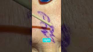 SCAR REVISION WITH GBLC (GEOMETRIC BROKEN LINE CLOSURE) - DR. TANVEER JANJUA - NEW JERSEY