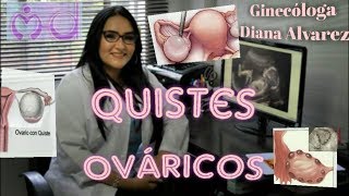 QUISTES OVARICOS POR GINECOLOGA DIANA ALVAREZ