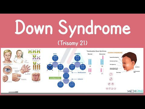 Down syndrome (Trisomy 21) - causes, symptoms, diagnosis, & pathology