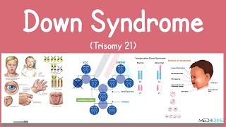 Down syndrome (Trisomy 21) - causes, symptoms, diagnosis, & pathology