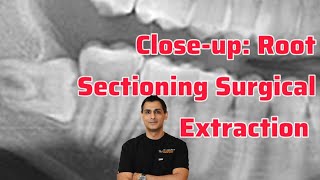 Horizontal Impaction with Dr. Wahan