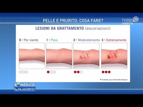 Il palmar e la psoriasi di piantatore quello che è questo La dermatite di atopic chi rivolgersi
