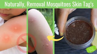 Home Remedies |Get Rid Of Mosquitoes Bites Scars |Allergies | Natural Treatments|Repellent |Natural