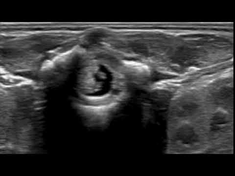 Spinal US lateral decubitus
