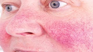 How to Get Rid of Rosacea Permanently - 5 Remedies for Reduce Redness.