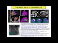 7 8 20 Bradfield Outflow PVC:VT Ablation