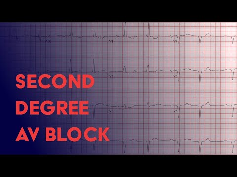 Second Degree Heart Block -  Electrocardiogram (ECG/EKG) Interpretation